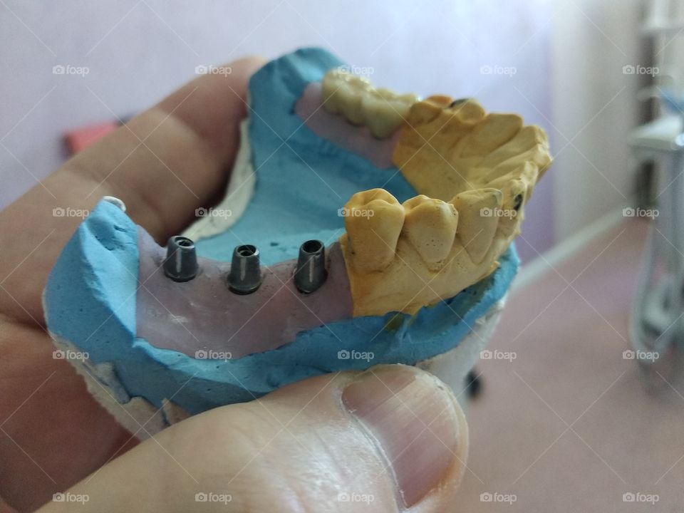 dental, dentistry, implantant, clinic, ceramic, crown, model, gypsum, modern, laboratory