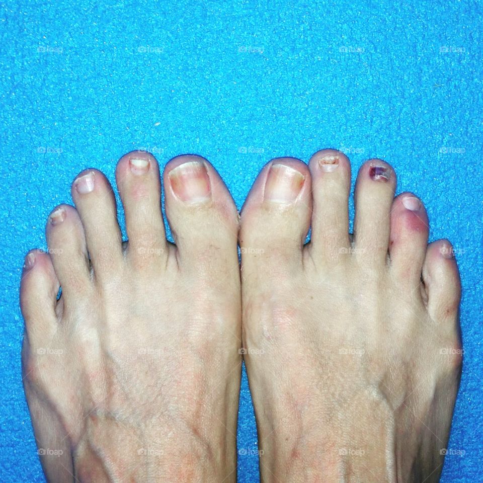 Runners toes. These are my toes after years of marathon training.  I've broken at least two, lost numerous nails.  Proud of my feet!