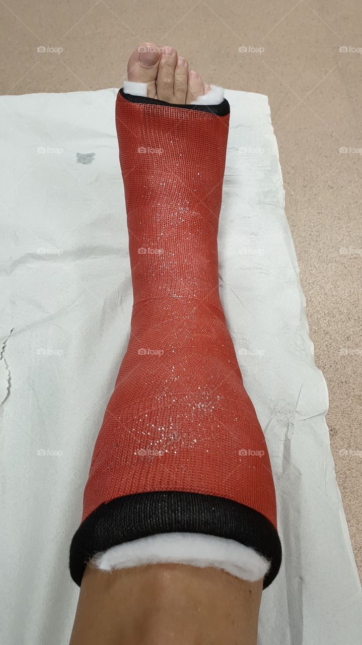 Red short leg cast with glitter, foot surgery , rött gips med glitter underben fotoperation 