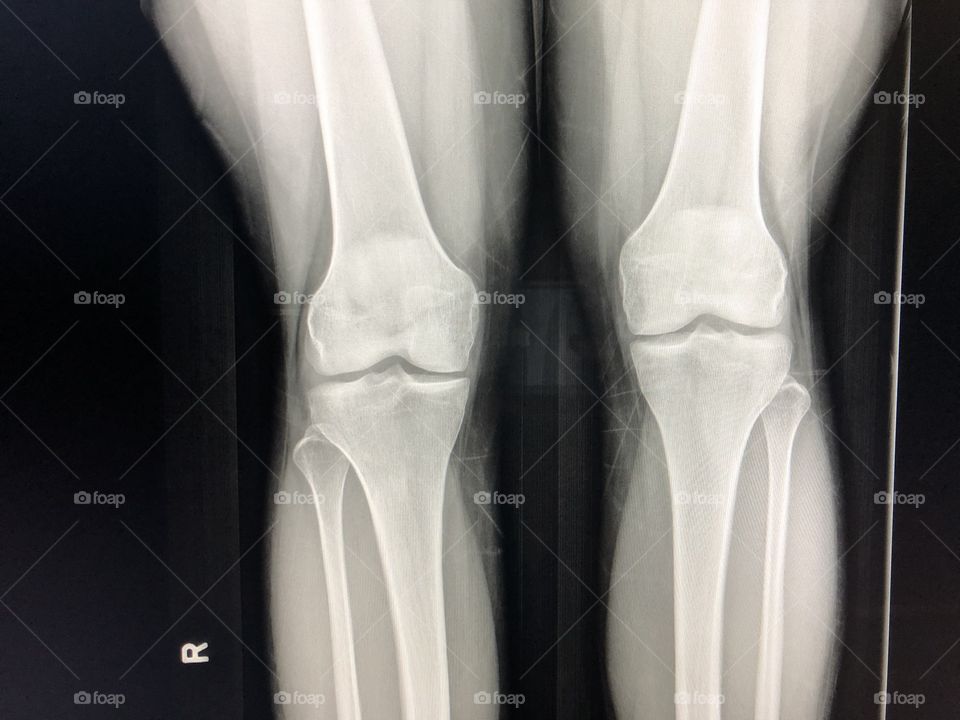 X-ray of my knees