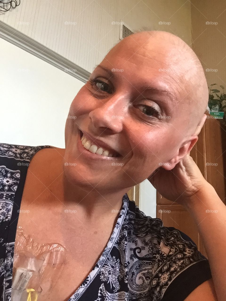 My bald head after chemo