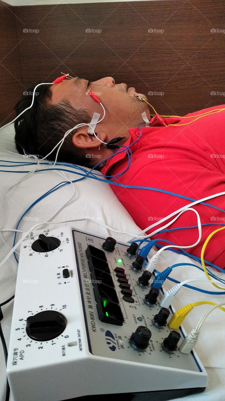 Acupuncture therapy alternative treatment