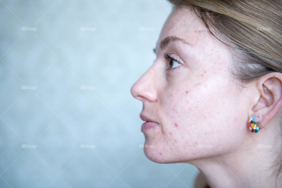 Close-up profile of a young millennial woman with acne prone skin