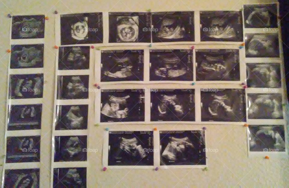 Kearon's Wall O Baby. 12 weeks worth of ultrasounds