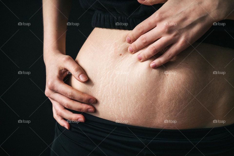 a woman's stomach after the birth of a child, stretch marks on the skin. The concept of loving your body and taking care of yourself. Touching moments of motherhood.