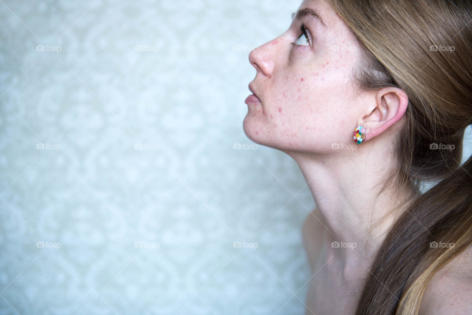 Profile portrait of a young millennial woman with acne prone skin