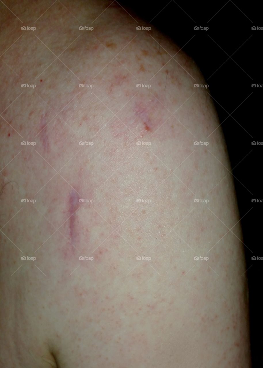 shoulder surgery scars