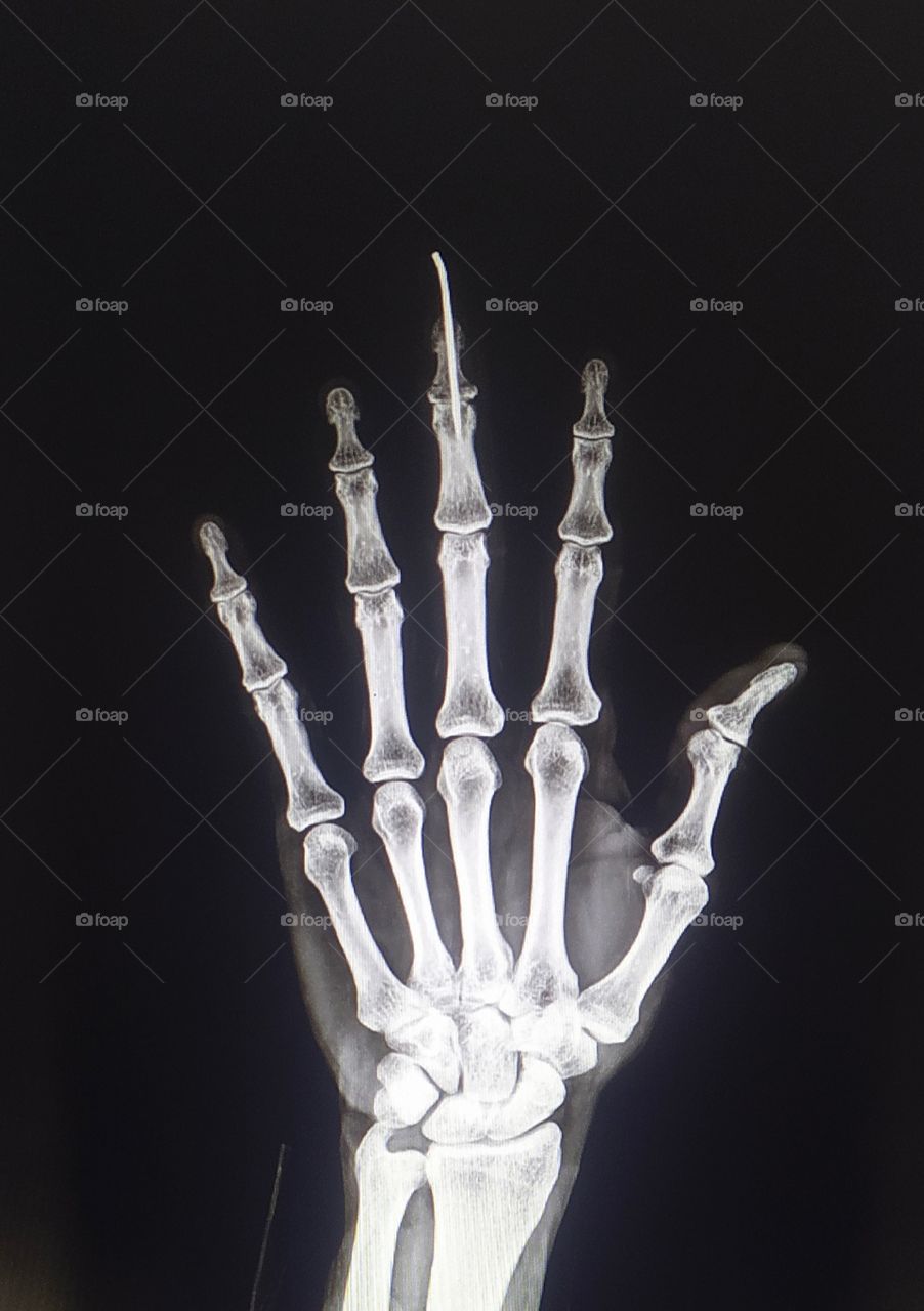 Post operative K-wire Hand AP Xray view