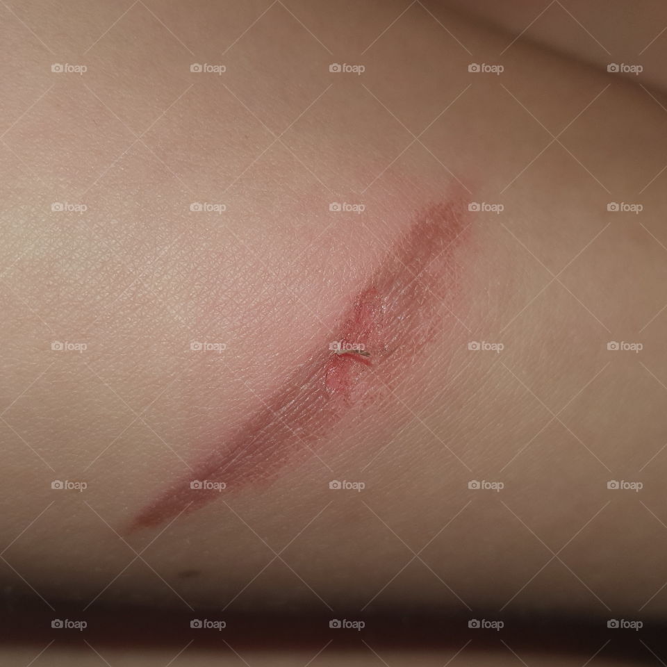 Burn blister from hot oven. On the forearm.