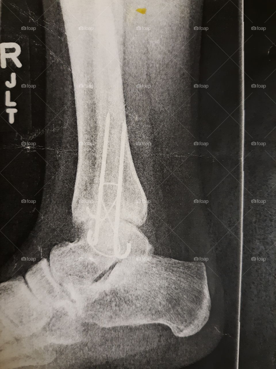 1 of 2 - My right ankle 2nd surgery after being shattered all around. 2pins and tie wire bone graph to hold graphed bone between the bone that was split in half and not mending on the left side of ankle
