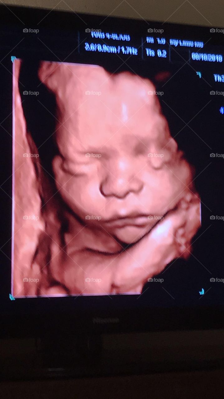 3d ultrasound! It’s amazing how accurate these pics can be such a beautiful blessing to have and amazing picture of a beautiful soul that’s soon to be here!