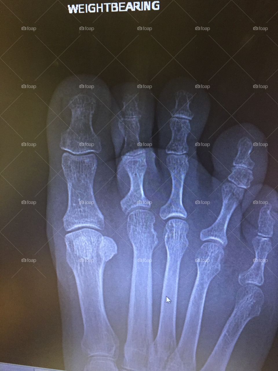 Foot X-ray 