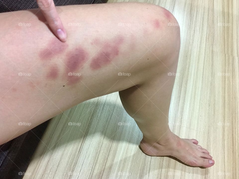 A leg Bruise