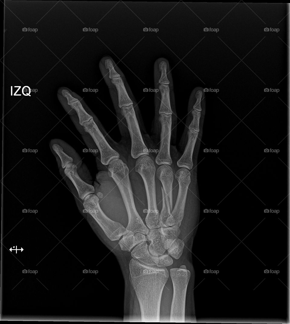hand's xray