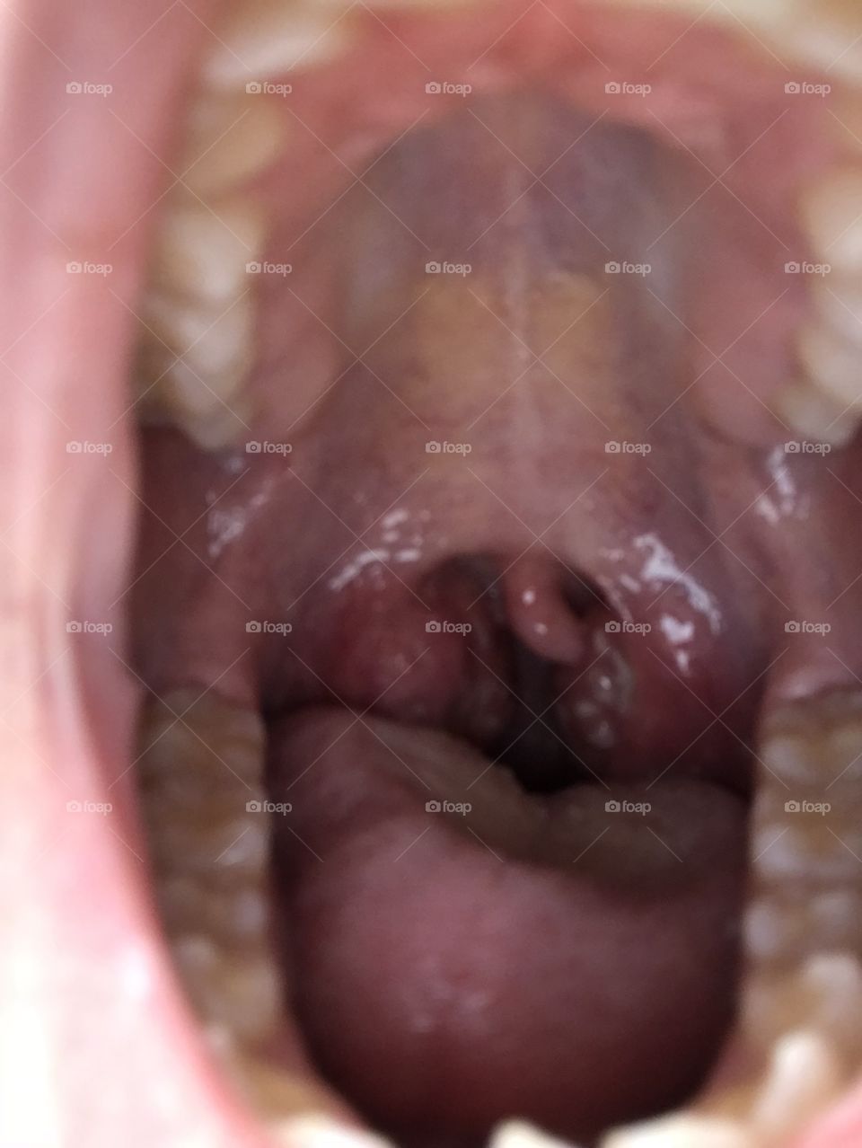 Swollen Tonsils 