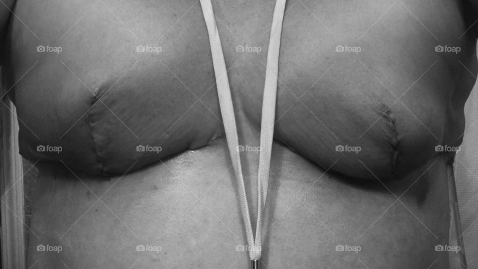 Expending Process Breast Expanders 