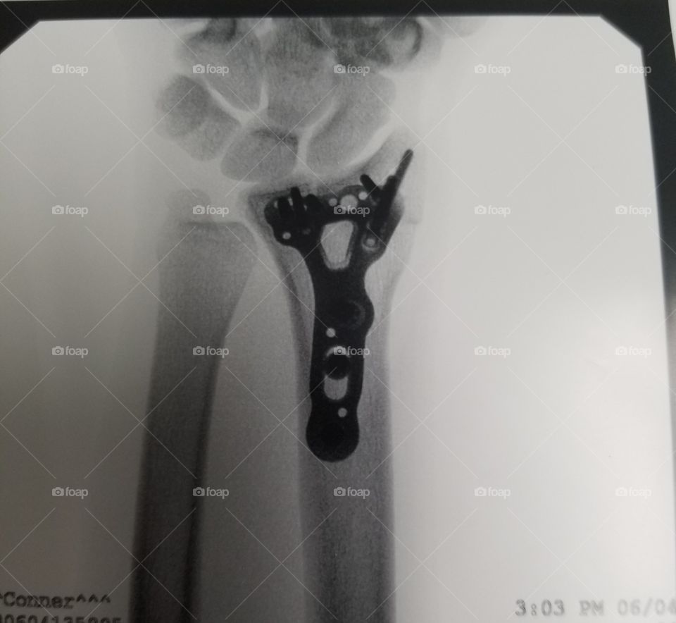 Wrist Surgery