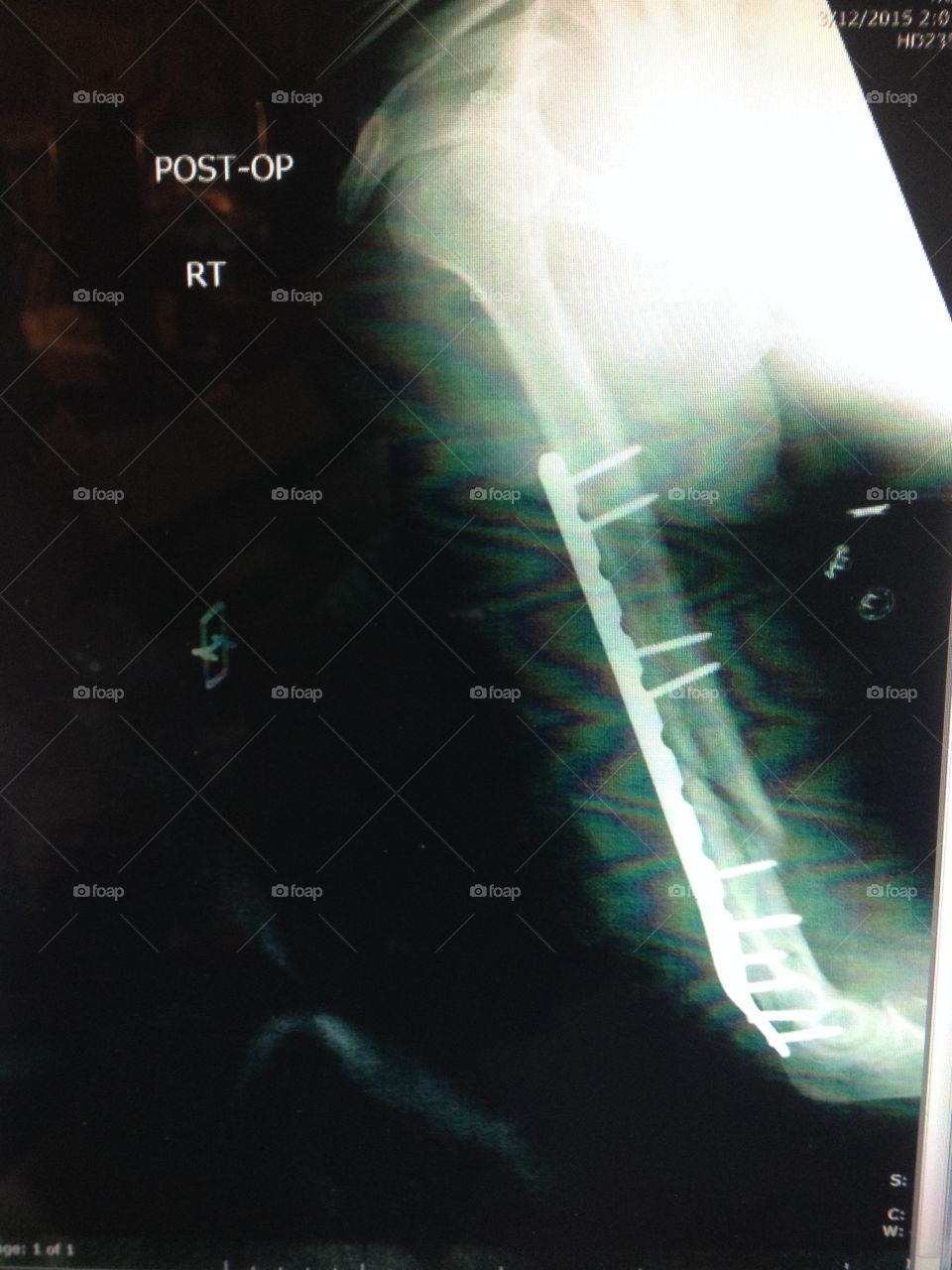 X-ray of broken distal Humerus. This is an X-ray of my broken distal humerus immediately after surgery. My arm now has a plate and ten screws in it. 