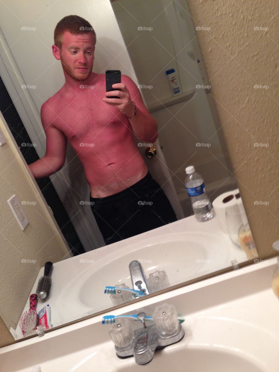 Shoulda put on sunscreen!