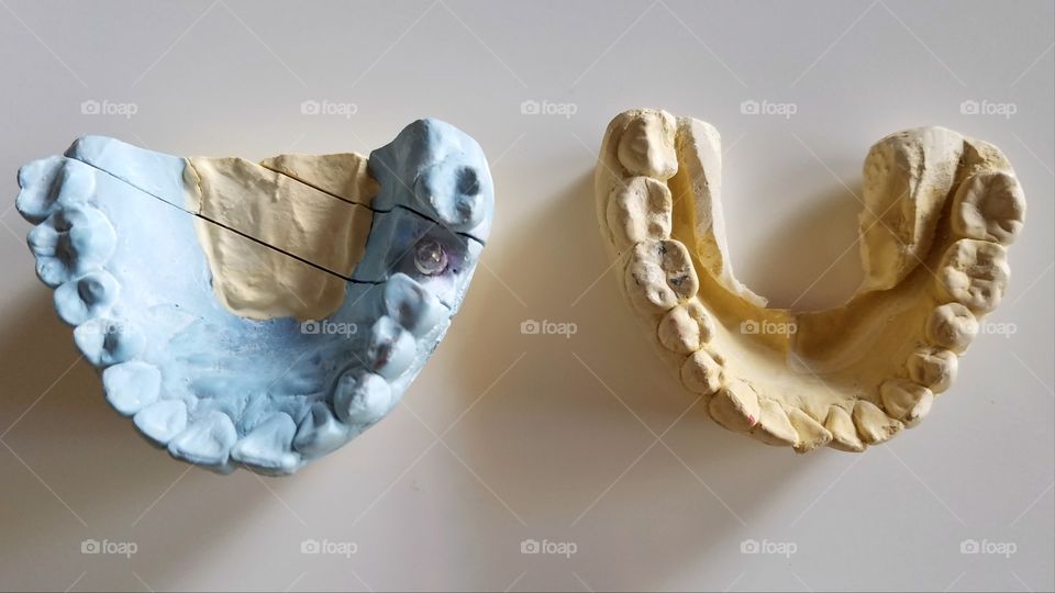 Dental mold impressions