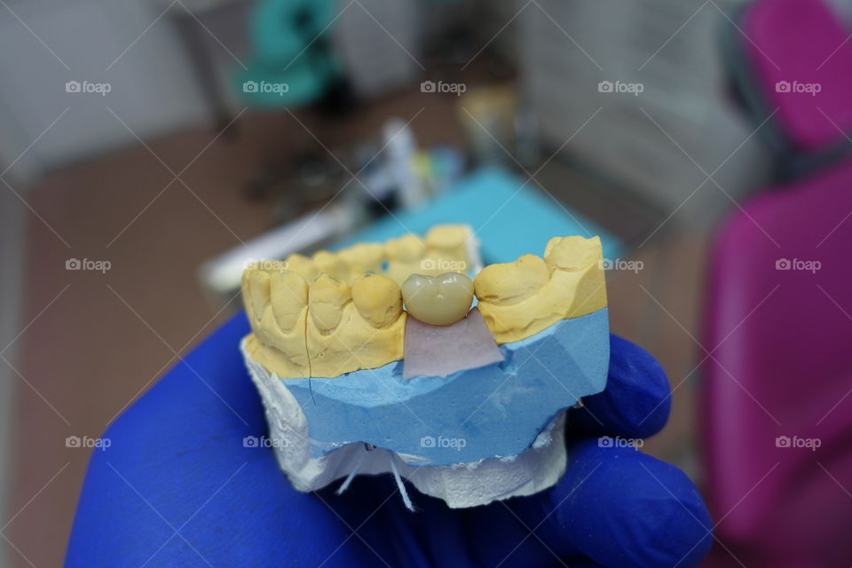 Dental crown on implantant