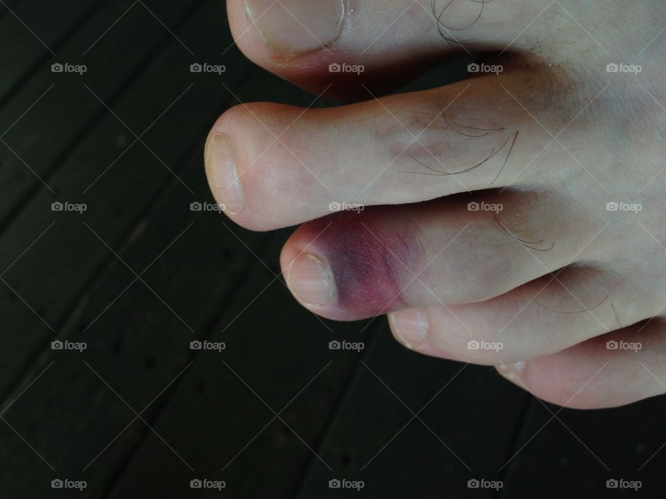 Dark purple bruised broken toe on a man's foot