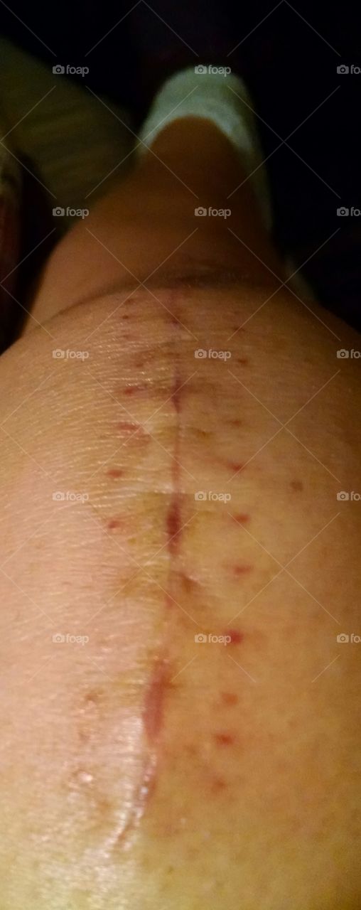 Healing Surgical Wound