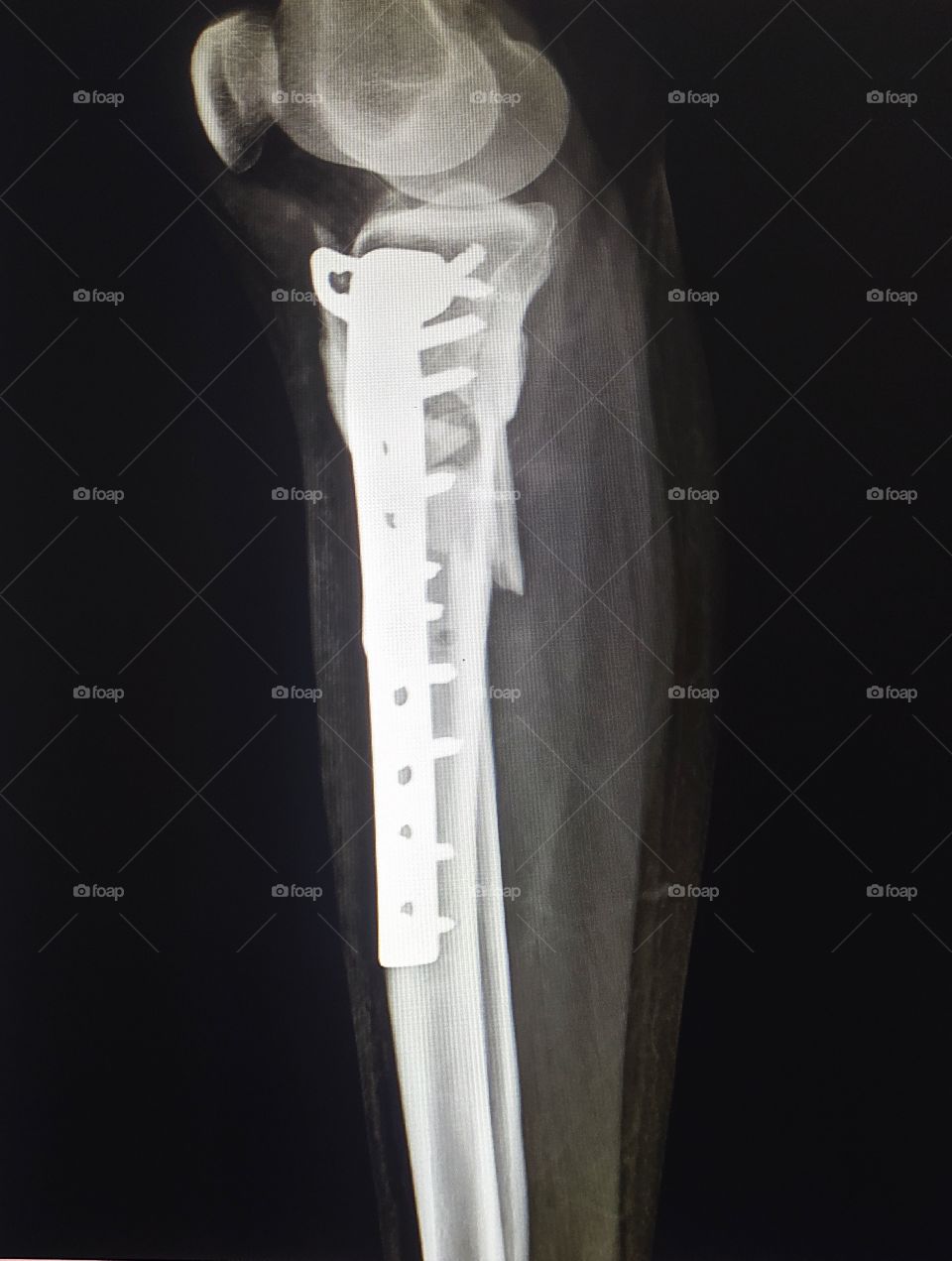 Tibia Plateau Fracture Post Oprative Lateral View X-ray