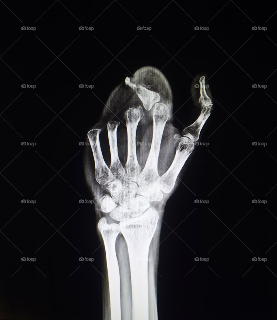 Xray of Hand AP view shows accidental injury broken fingers