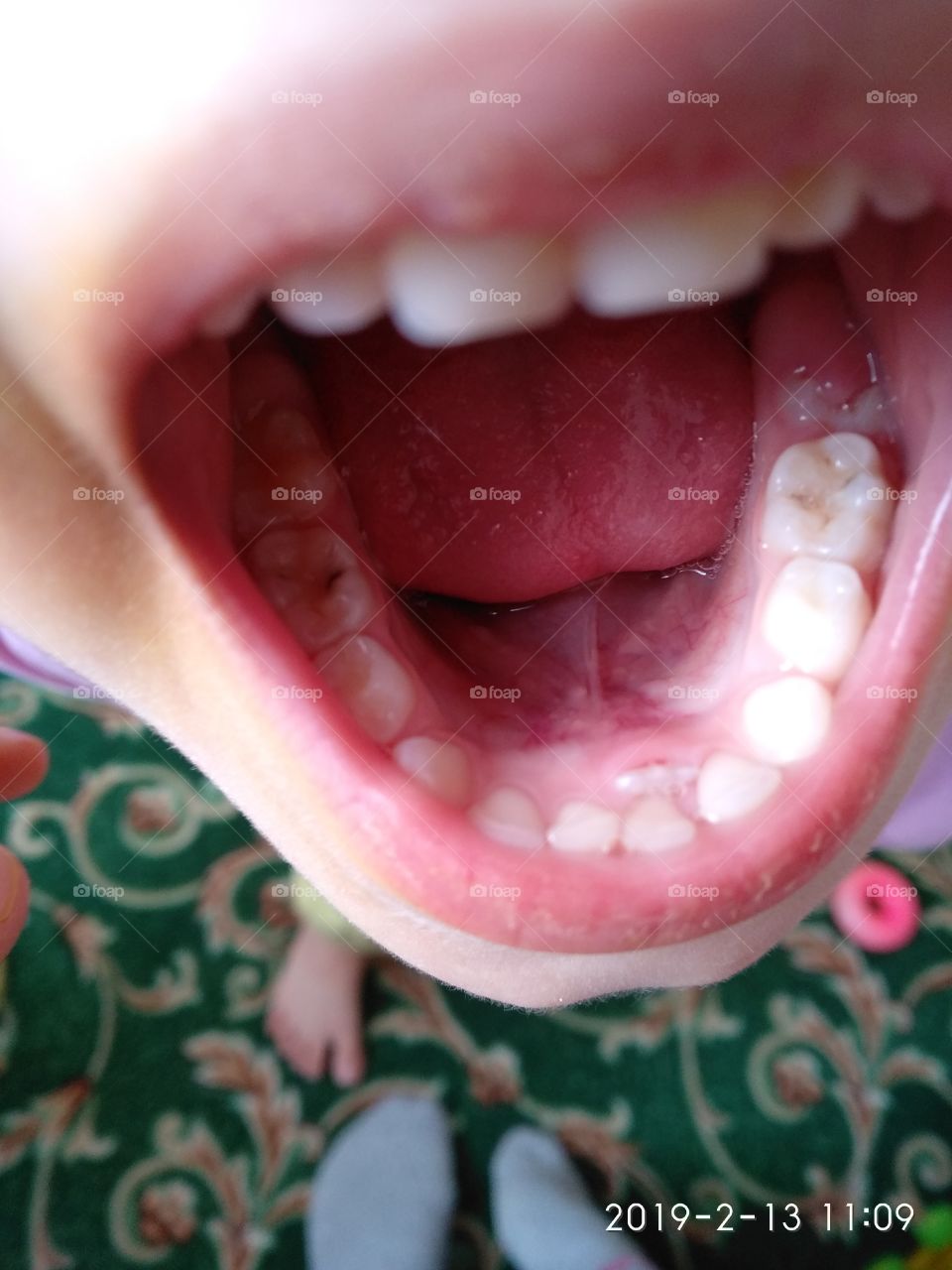 Do you see the first real  teeth?