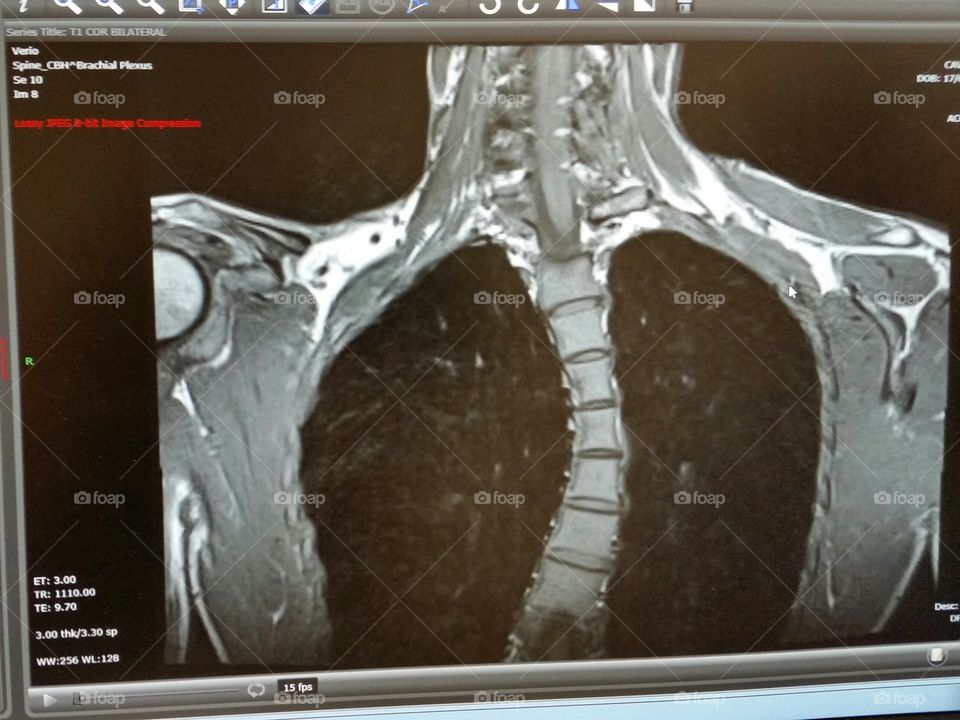 crooked back x-ray