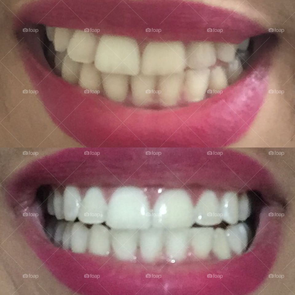 Dentes amarelos nunca mais, #clareamento #dentário