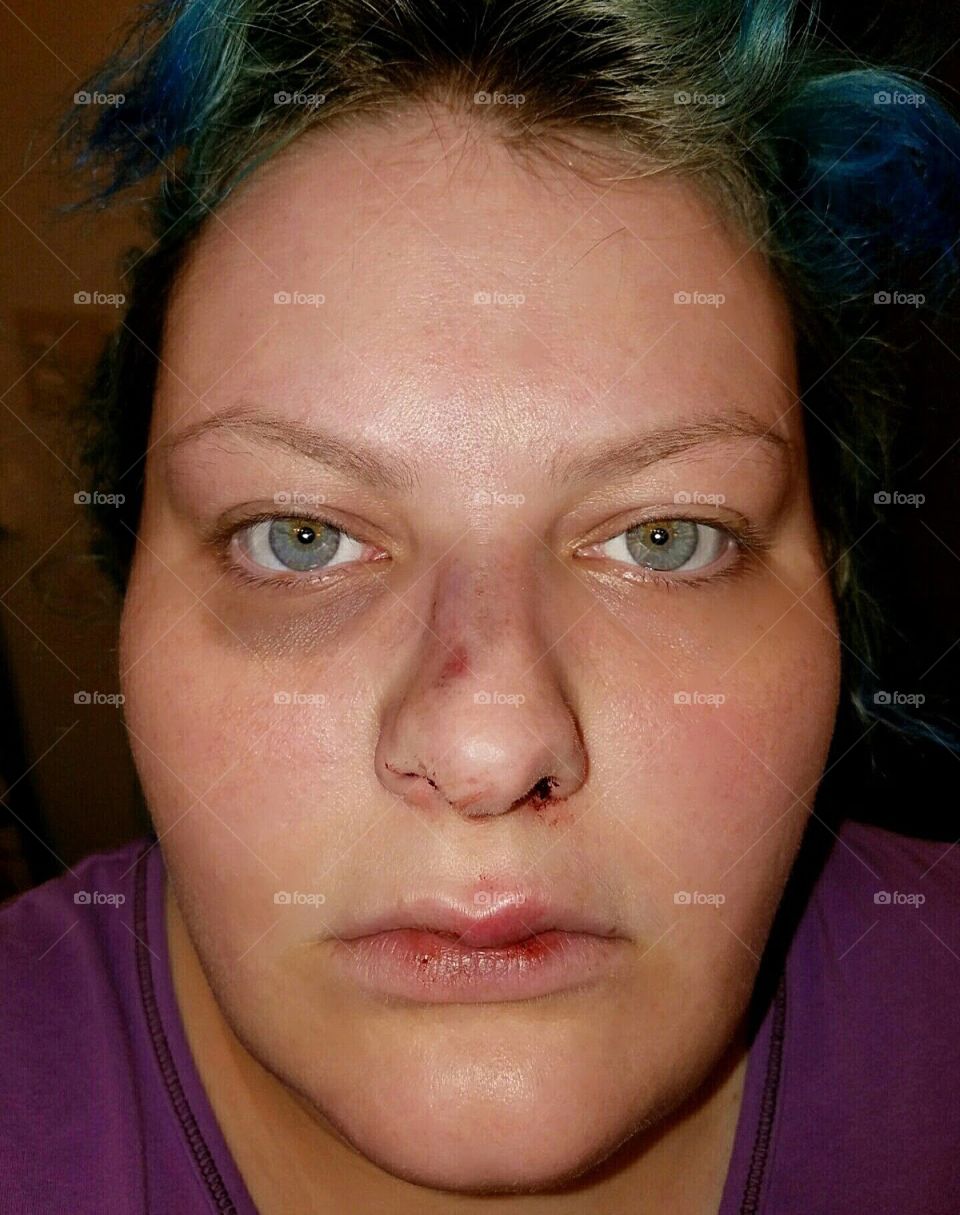 View of a woman with a bruised face