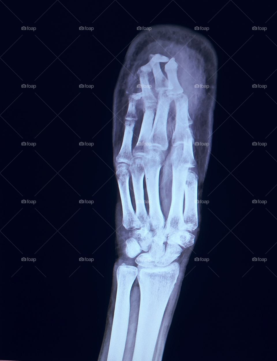 Xray Of Hand Ap view shows accidental injury in industrial area