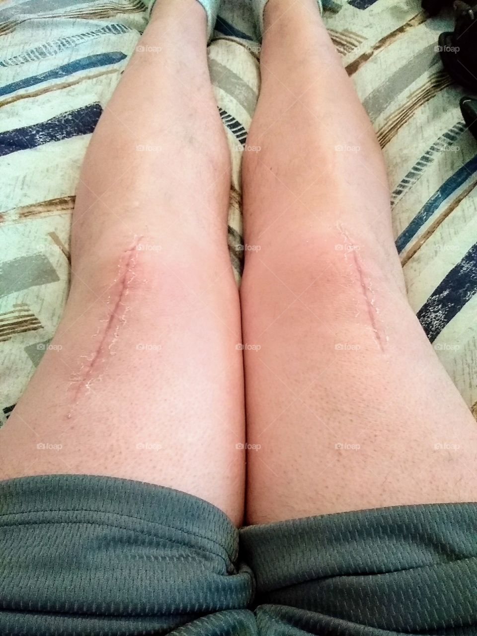 knee surgery scars.