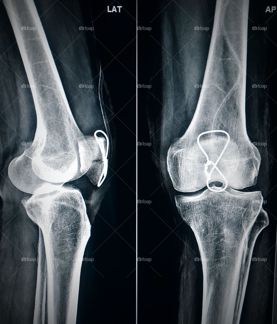 Patella Fracture post operative X-ray view