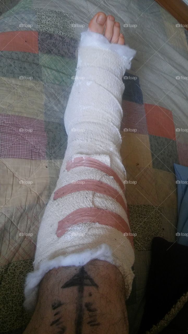 Bandaged Leg