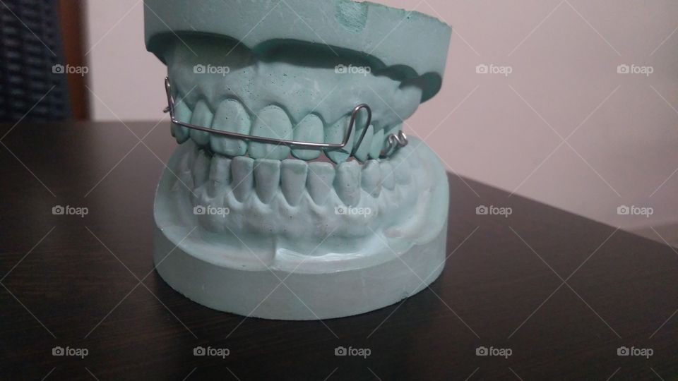 Denture wire brace