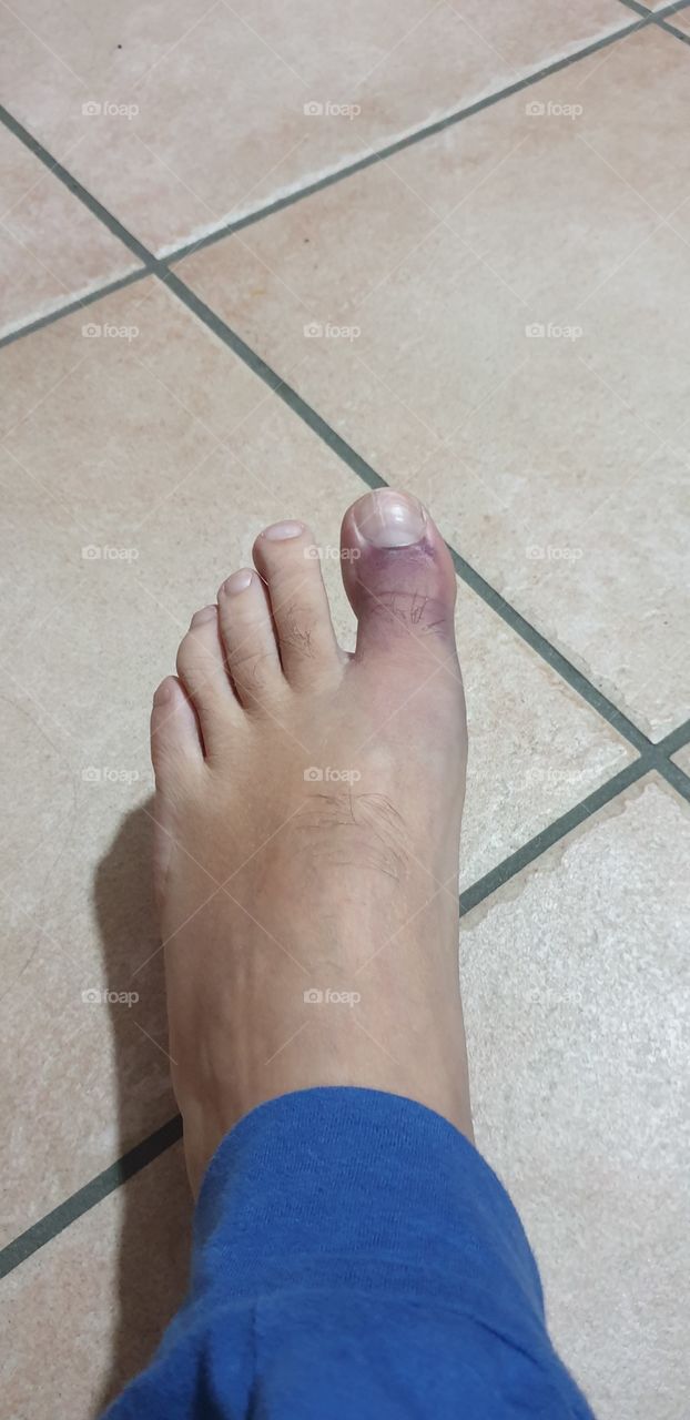 bruised big toe