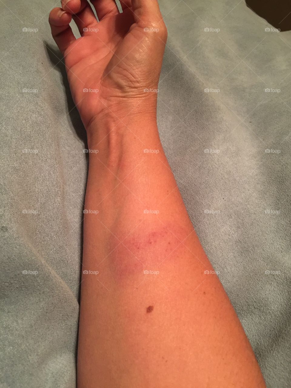 Bruised arm 